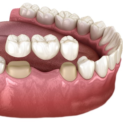 dental bridge