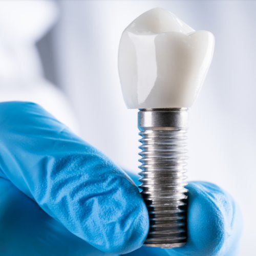 dental implants