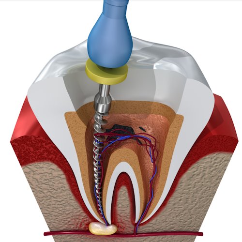 root canal illustration