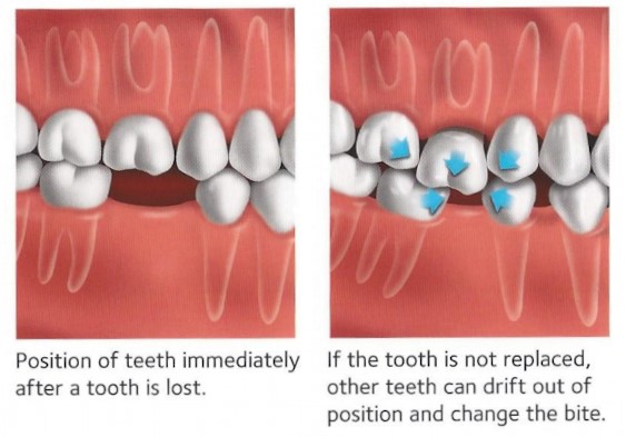 drifting teeth 1