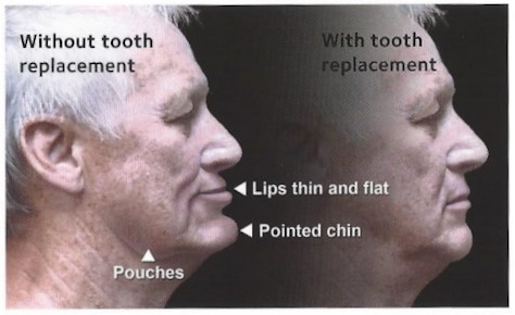 facial collapse 1