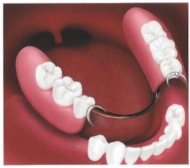removable partial dentures ill 1