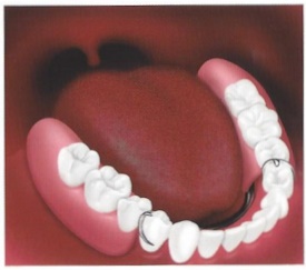 removable partial dentures ill 2