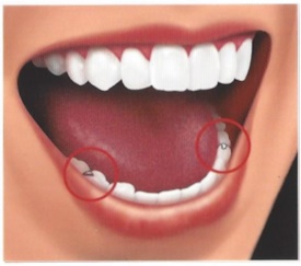 removable partial dentures ill 3