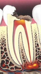root canal illustration 2