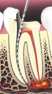 root canal illustration 3