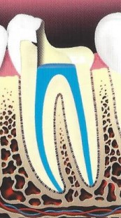 root canal illustration 5