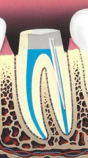root canal illustration 6