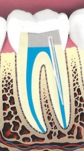 root canal illustration 7
